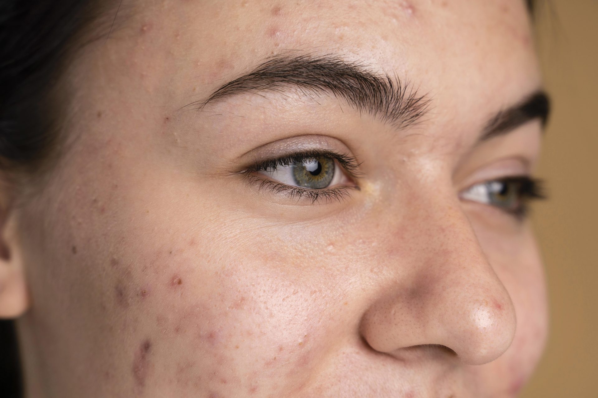 Close view of a woman's face with green eyes and visible red blemishes on cheek and forehead